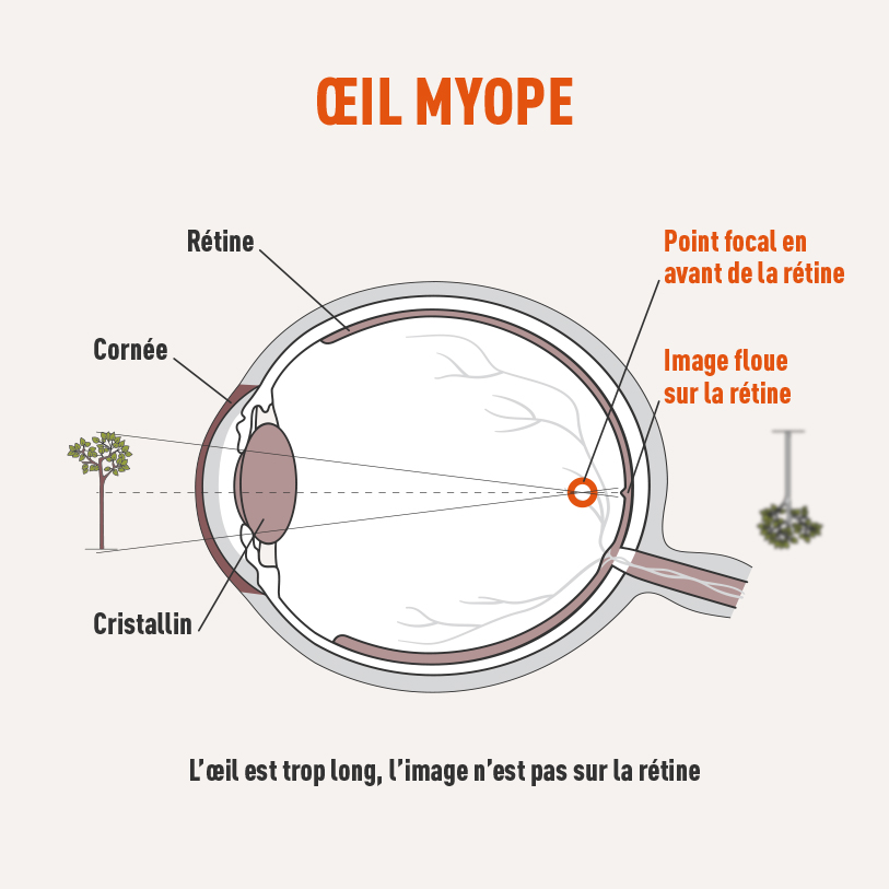 Oeil avec myopie