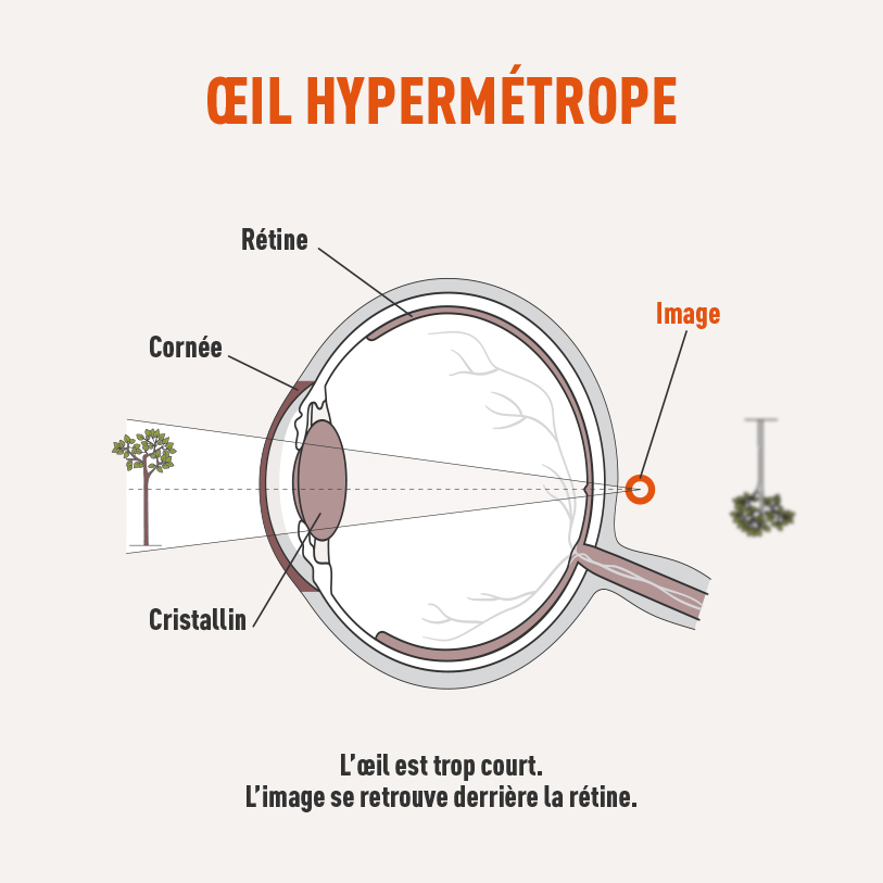 oeil hypermétrope