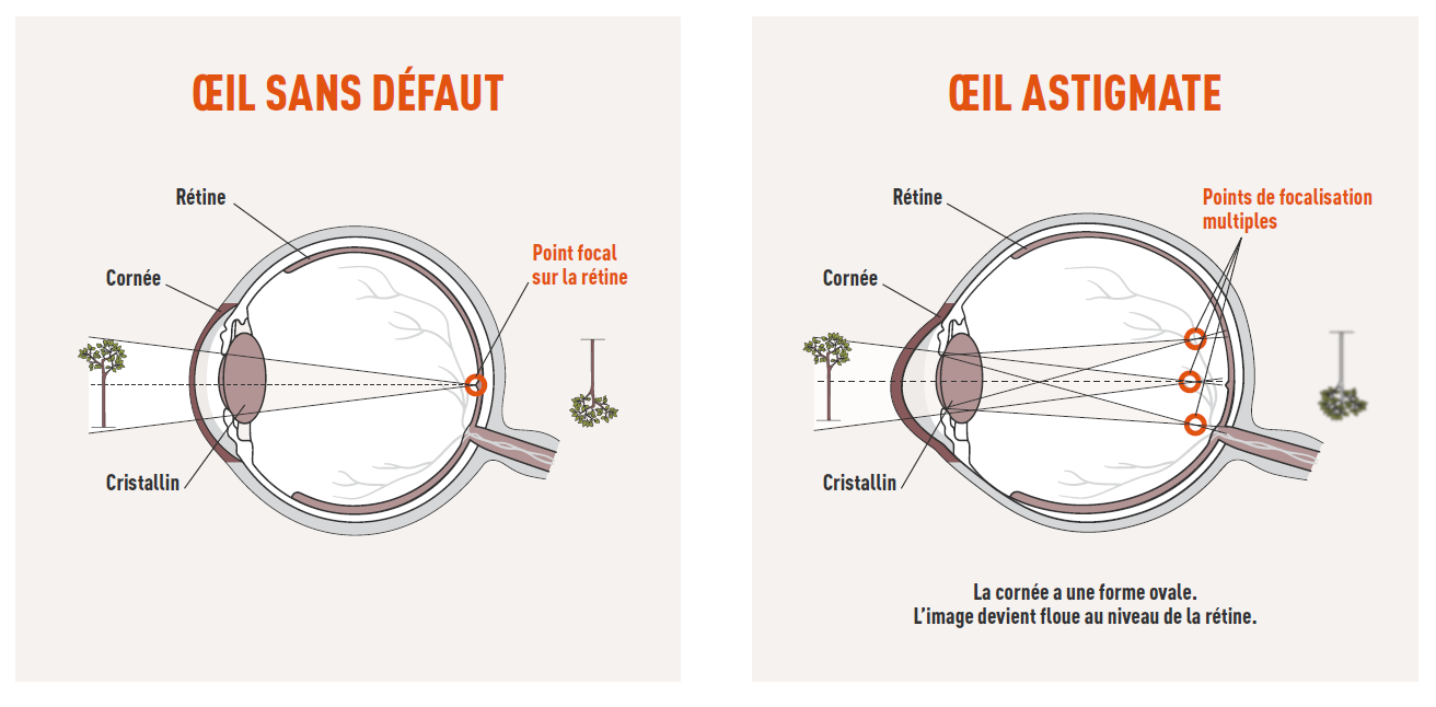 Oeil sans défaut/oeil astigmate